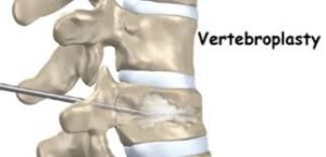 Vertebroplasty in India