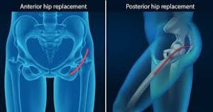 Hip replacement surgery in India